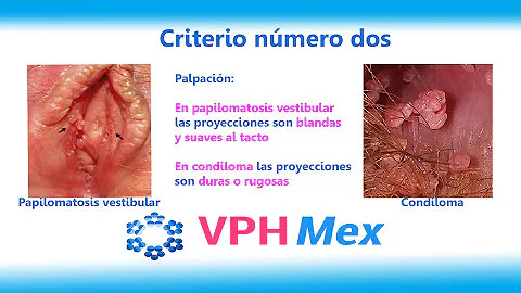 Como surge a papilomatose vestibular?
