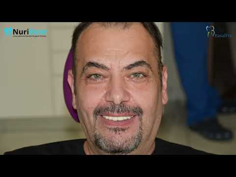 ابتسامة جديدة لمدة 3 أيام مع غرسات  في عيادة  بلغاريا