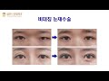 Revision blepharoplasty  before  after symphony plastic surgery korea  complex cases
