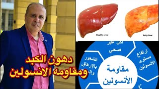 مفاجأه دهون الكبد سبب مقاومه الانسولين علامات خطيره في جسمك تخبرك بتشحم الكبد ومقاومه الانسولين