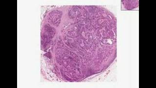 Histopathology Lymph node --Adenocarcinoma, metastatic to ly