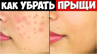 ЭКСПРЕСС МАСКИ от Прыщей для Сухой и Жирной кожи
