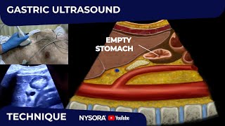 HOW TO: GASTRIC ULTRASOUND by NYSORA - Education 8,660 views 2 months ago 5 minutes, 6 seconds