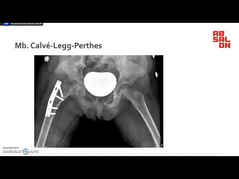 Video: Dysplasi Af Hofteleddet Hos Børn