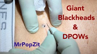 Large blackheads extracted. DPOWs packed full of content expressed. Spectrum of blackheads displayed