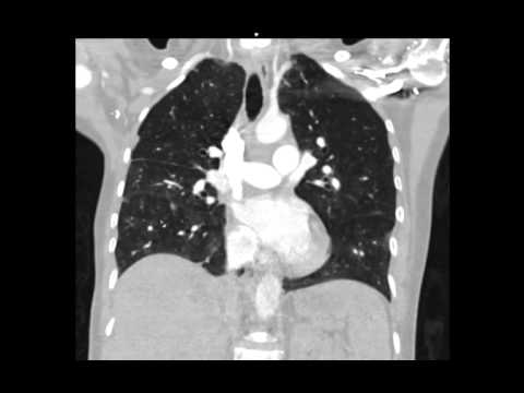 Type A Aortic Dissection with Acute Bilateral Lower Extremity Paralysis and Retroperitoneal Hematoma