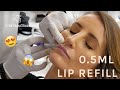 0.5ML LIP REFILL | NATURAL LOOKING FULL LIPS | LIP FILLERS | VIVA Skin Clinics