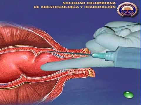 Video: Protuberancia Del Recto Y El Ano En Hurones