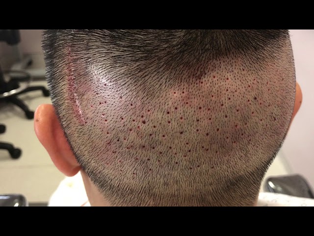 Asian FUE Hair Transplant Scar Revision Immediately After