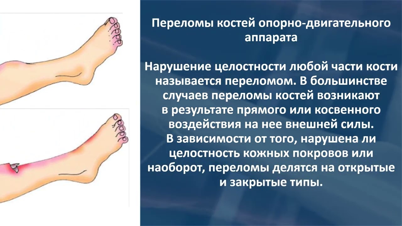 5 ТРАВМЫ ОПОРНО ДВИГАТЕЛЬНОГО АППАРАТА