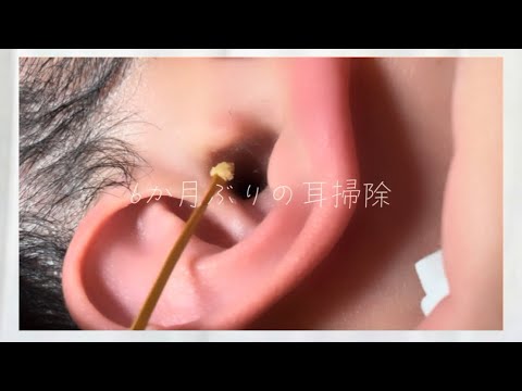 Видео: [耳掃除]6か月ぶりの右耳