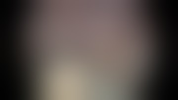 RT ICA SEGMENTS ENDOSCOPIC VIEW-dissection with DR IYPE CHERIAN