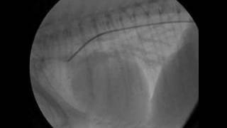 Patent Ductus Arteriosus Angiogram PreCoil