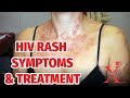 How to Identify HIV Skin Rashes and How It Can Be Treated
