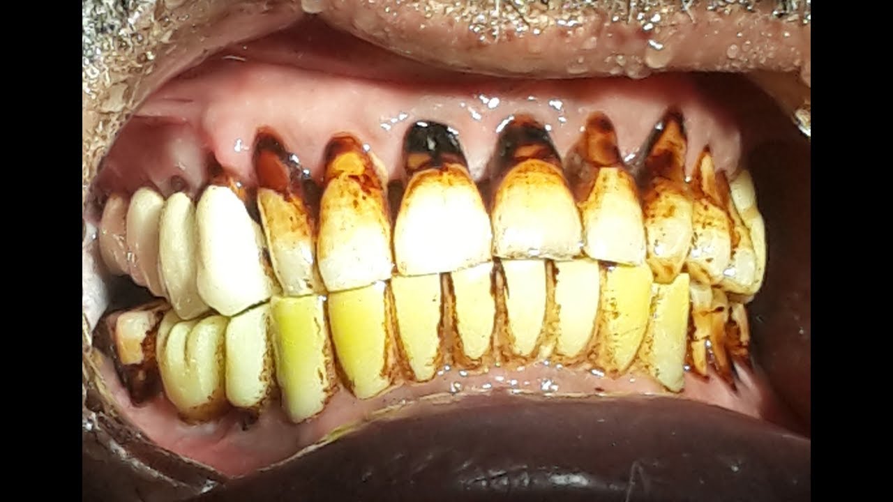 Stain removal procedure YouTube