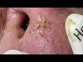 Nose  blackheads removal with haris beauty  2022