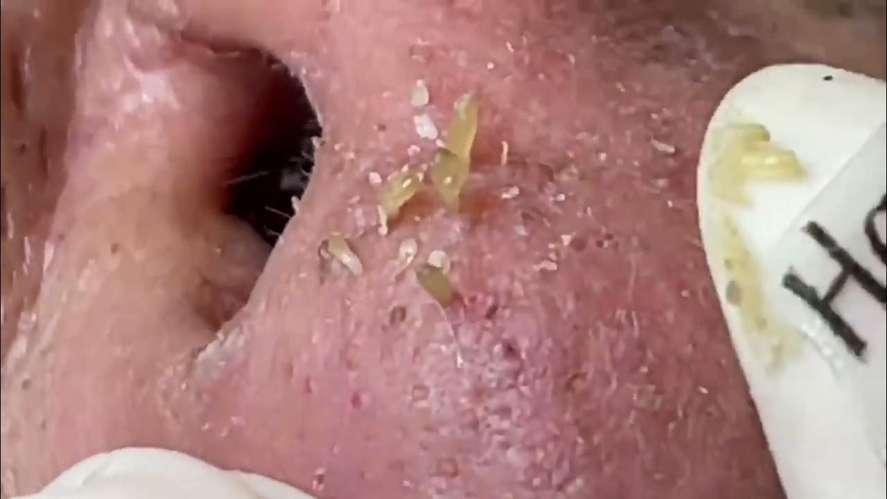 Nose Blackheads Removal with Hari's Beauty 2022 YouTube