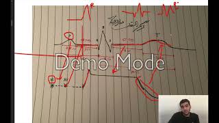 ECG highlights pt1. ( leads and normal ECG )