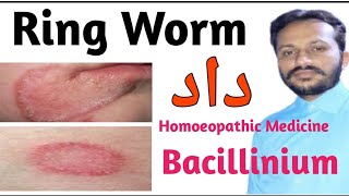 Bacillinium 200 for Ring Worm || Best Homeopathic Remedy For Ring Worm by Homoeo Stars Official