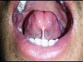 Lingual frenectomy Dr Amit Mohan