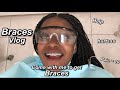 Braces Vlog | Come with me to get braces !!