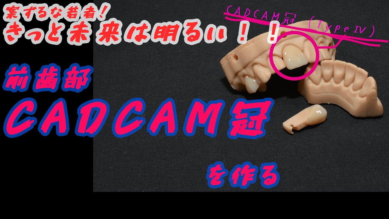 【歯科技工】IOSデータで前歯CADCAM冠を作る。しかもプリントモデルも作る。