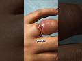 How to Remove a Stuck Ring Without Hurting Yourself