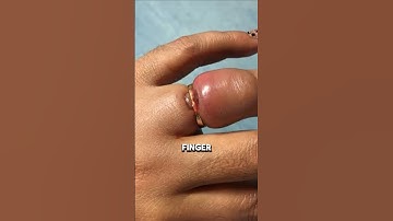 How to Remove a Stuck Ring Without Hurting Yourself