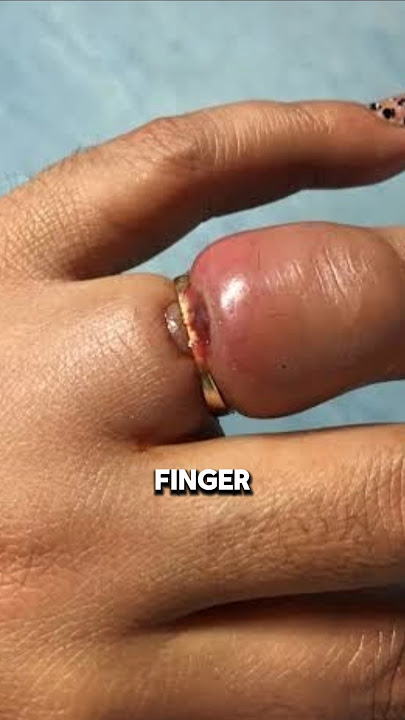 How to Remove a Stuck Ring Without Hurting Yourself