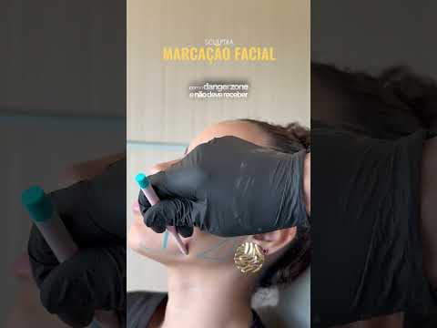 Sculptra: o mapa de segurança antes de aplicar no rosto — vídeo do Dr. Thiago Perfeito