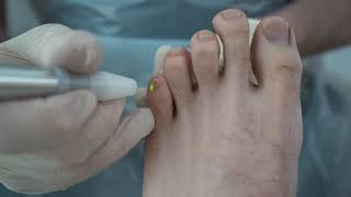 Fungal Nails