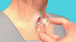 02- InHealth Technologies- Blom-Singer Speakfree HME - How to insert SpeakFree HME Handsfree Valve