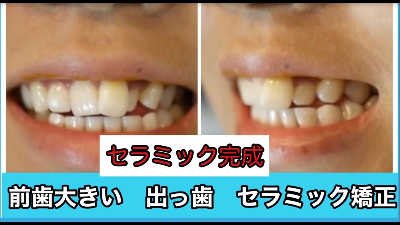 女子大生 就活 短期間セラミック矯正体験 八重歯 叢生 Youtube