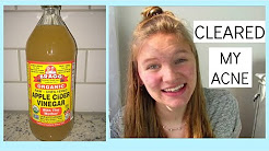 HOW I CLEARED  MY ACNE WITH APPLE CIDER VINEGAR | Grace Jennings