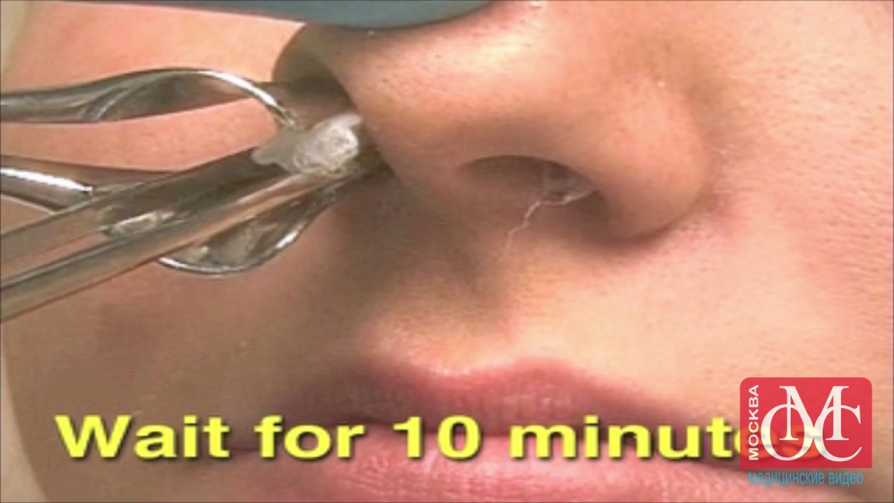 Лечение гематомы носовой перегородки - YouTube