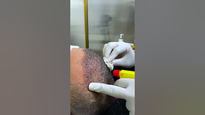 First Shampoo Headwash after Hair Transplant | Cara Clinic