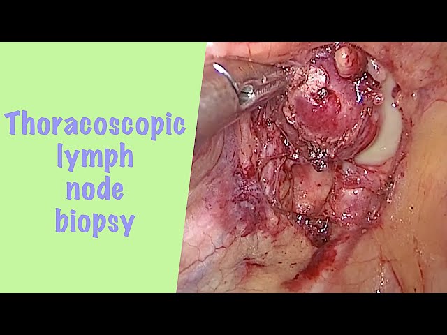 Thoracoscopic biopsy of a superior mediastinal lymph node