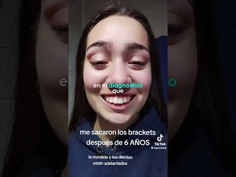 Ortodoncia  ¿Cirugía o sin Cirugía?