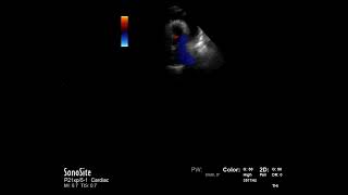 How to...Measure Mitral Inflow Variation