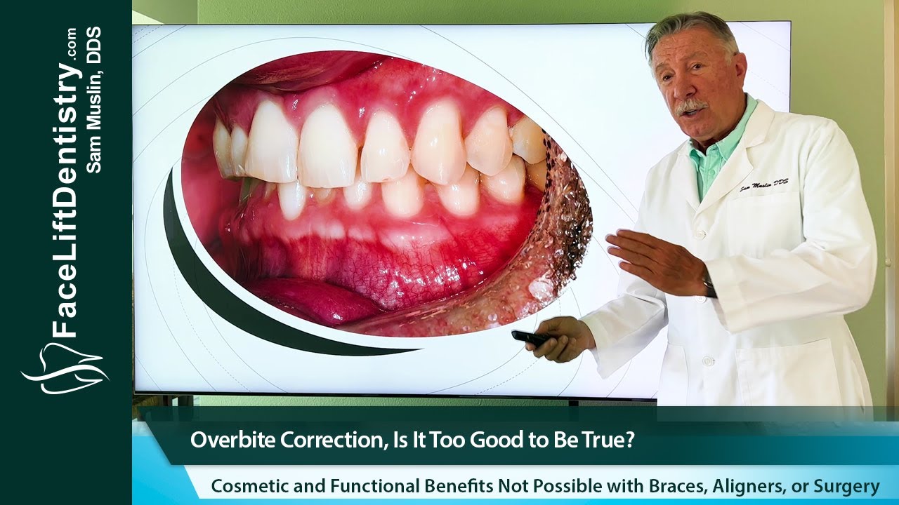 Video: Overbite Correction in a Month Explained