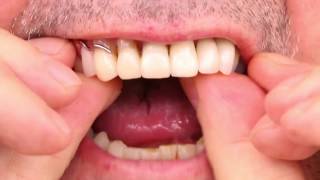 Partial Denture Video