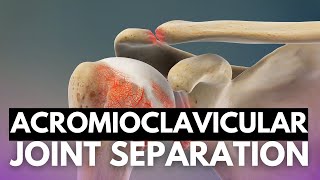 Celebrity Acromioclavicular Joint Separation: Navigating Symptoms and Treatment Net Worth