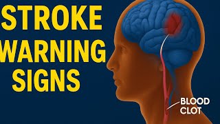 Stroke Explained: Warning Signs, Causes, and How to Prevent It |