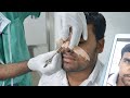 Rhinoplasty Before and After - Splint Removal | Nose Job Before After Experience