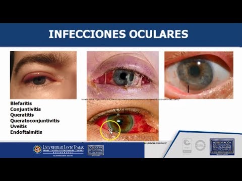 Vídeo: Secreción Del Ojo Blanco: Causas, Tratamiento Y Más