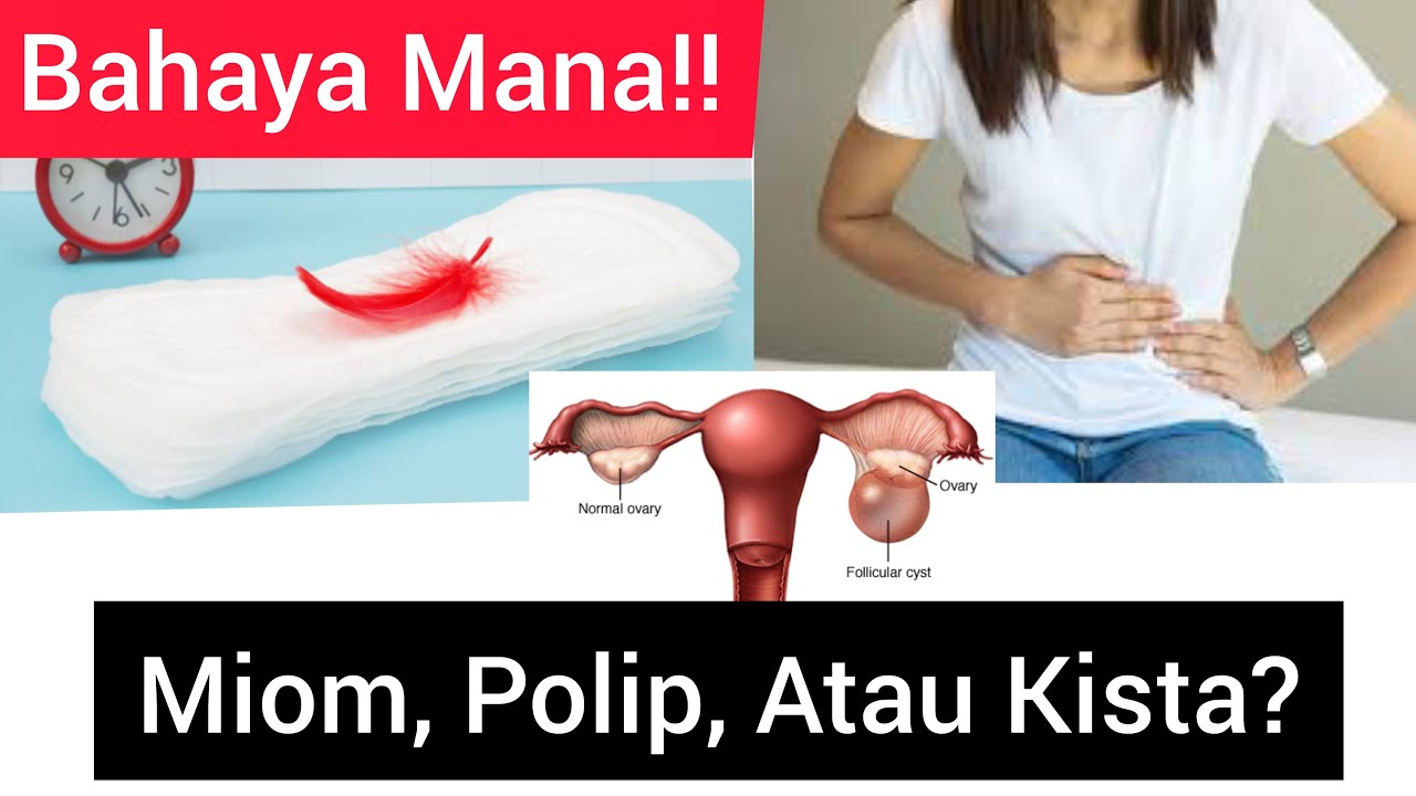 Bedanya Apa Itu Miom, Polip, & Kista ? Kelainan Pertumbuhan Jaringan Bedanya Apa Itu Miom, Polip, & Kista ? Kelainan Pertumbuhan Jaringan