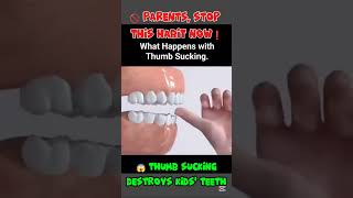 😱 Thumb Sucking Dangers Every Parent Must Know! 😢 Thumb Sucking Destroys Teeth & Jaw #Thumbsucking
