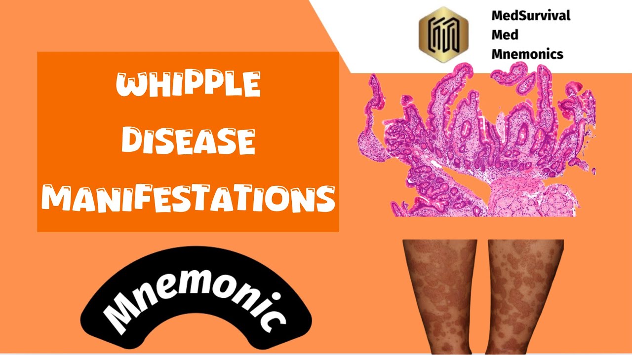 Whipple Disease Presentations: The Easy Mnemonic!