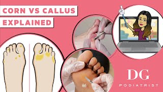 CORNS VS CALLUS EXPLAINED: HOW CAN I CHECK IF I HAVE, WHAT IS THE DIFFERENCE BETWEEN CORN AND CALLUS