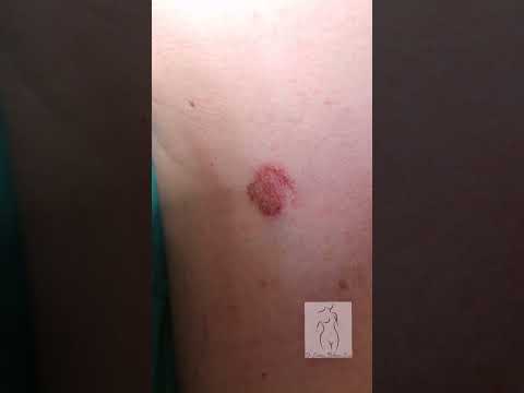 Video: Siguranța și Eficacitatea Vismodegib La Pacienții Cu Sindrom Nevus De Carcinom Cu Celule Bazale: Analiză Comună A Două Studii